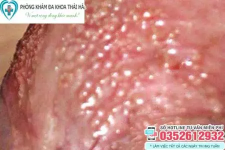 Dương vật nổi mụn trắng gây ngứa là bệnh gì