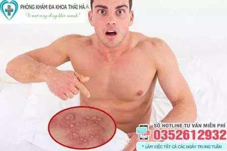 Dương vật nổi mụn trắng nhỏ li ti