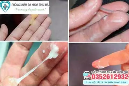Biểu hiện khí hư bất thường