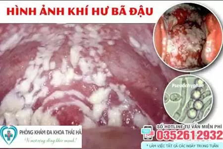 Khí hư màu trắng đục như bã đậu có mùi và ngứa