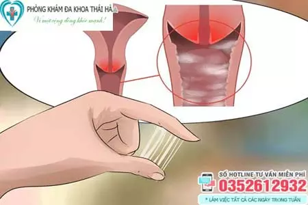 Cách chữa khí hư ra nhiều