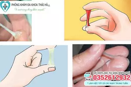 Cách chữa khí hư có mùi hôi