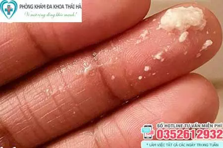 Hình ảnh khí hư như bã đậu