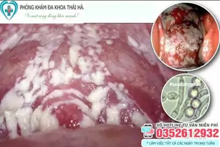 Cách chữa khí hư màu trắng đục có mùi hôi