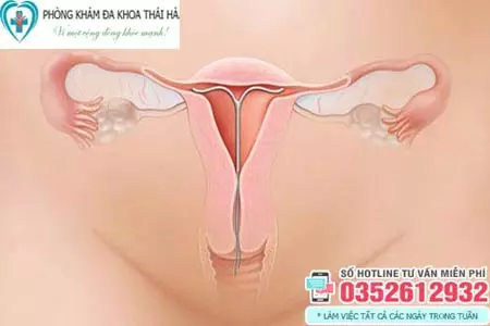 Tháo vòng tránh thai bao lâu thì có thể mang thai lại