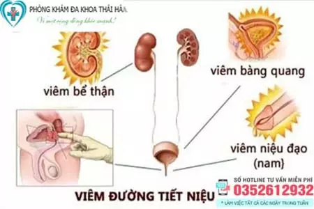 Viêm đường tiết niệu