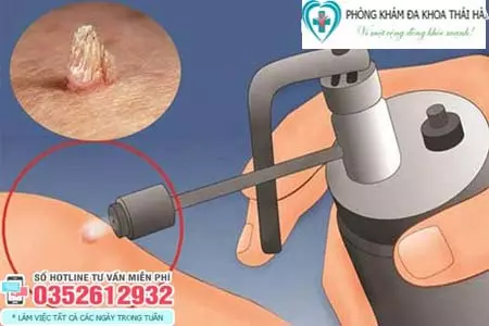 Đốt sùi mào gà bao lâu thì quan hệ được