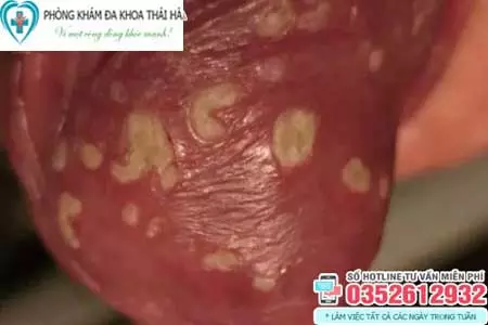 Hình ảnh bị nấm ở vùng kín nam giới