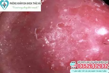 Hình ảnh bị nấm ở vùng kín nam giới