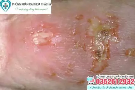 Hình ảnh bị nấm ở vùng kín nam giới