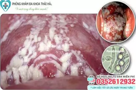 Hình ảnh bị nấm ở vùng kín nam