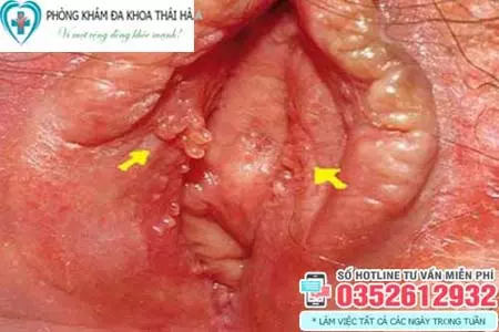 Hình ảnh mụn gai sinh dục nữ
