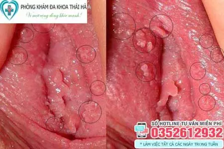 Hình ảnh mụn gai sinh dục ở nữ giới