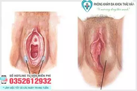 Hình ảnh cục thịt thừa ở vùng kín do u nang Bartholin