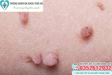 Hình ảnh cục thịt thừa ở vùng kín do sinh lý
