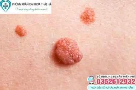 Cục thịt thừa ở gần vùng kín có nguy hiểm không