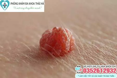 Hình ảnh cục thịt thừa ở ngoài vùng kín