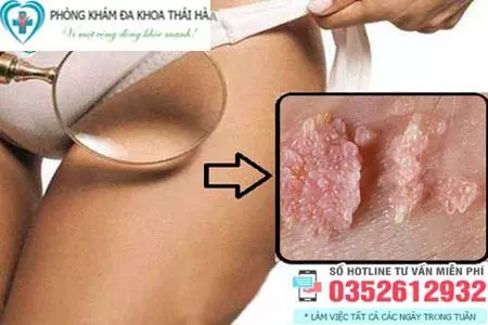 Hình ảnh cục thịt thừa ở vùng kín