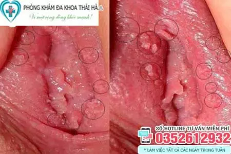 Hình ảnh cục thịt thừa ở vùng kín do sùi mào gà