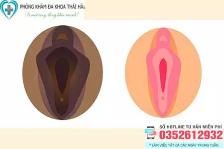 Hình ảnh vùng kín nữ thâm đen