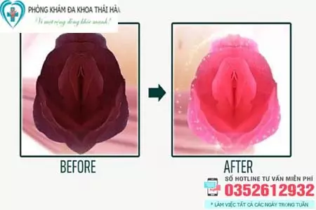 Cách khắc phục vùng kín bị thâm đen