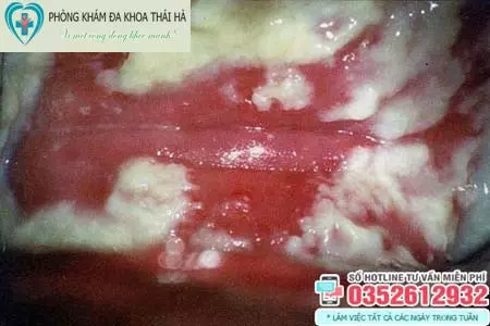 Hình ảnh bệnh nấm ở vùng kín