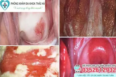 Hình ảnh nấm ngứa vùng kín