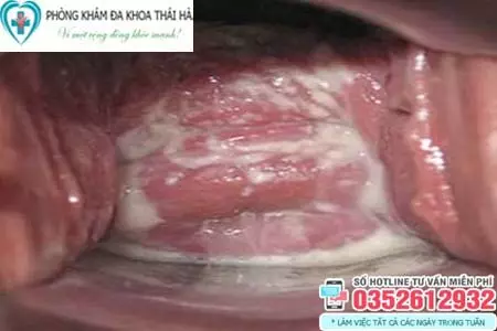 Hình ảnh vùng kín bị nấm Candida