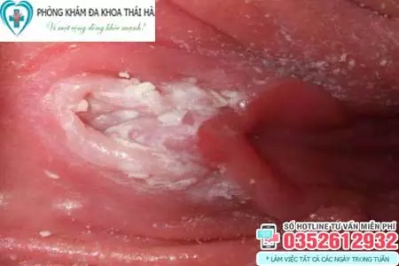 Hình ảnh nấm ở vùng kín