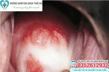 Cách trị nấm ở vùng kín nữ tại nhà