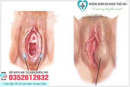 Hình ảnh nổi cục cứng ở mép vùng kín phụ nữ