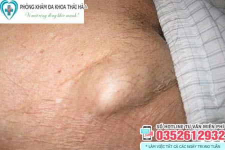 Hình ảnh nổi hạch ở vùng kín phụ nữ