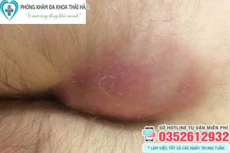 Nổi cục cứng ở vùng kín đau