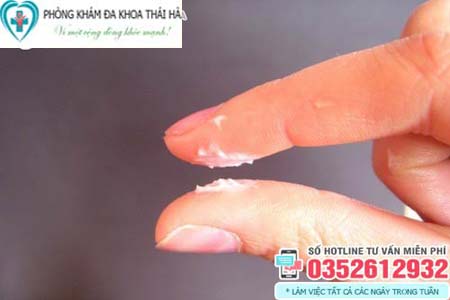 Vùng kín bị ngứa và có dịch trắng đục có mùi hôi