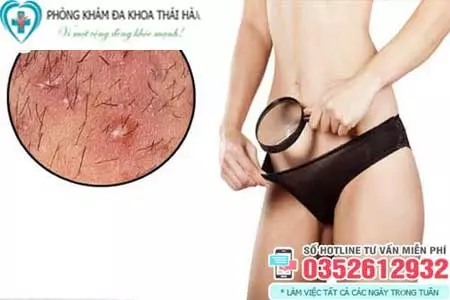 Nổi mụn ở vùng kín nữ là bệnh gì