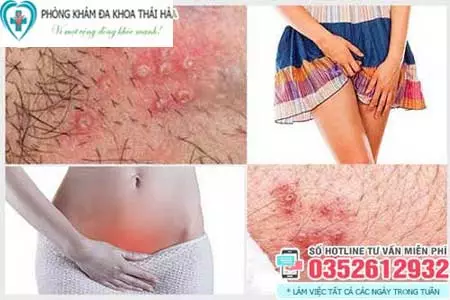 Hình ảnh nổi mụn ở vùng kín nữ