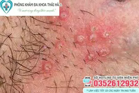 Hình ảnh nổi mụn ở vùng kín nữ do mụn rộp sinh dục