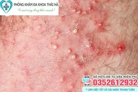 Hình ảnh nổi mụn ở vùng kín