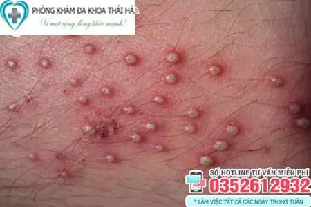 Hình ảnh nổi mụn ở vùng kín nữ do viêm nang lông