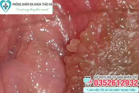 Hình ảnh nổi mụn ở vùng kín nữ do gai sinh dục