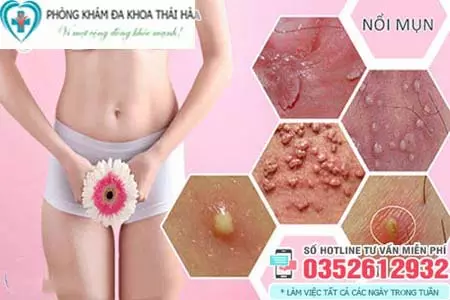 Cách chữa nổi mụn ở vùng kín nữ