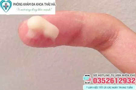 Hình ảnh vùng kín ra dịch trắng nhầy