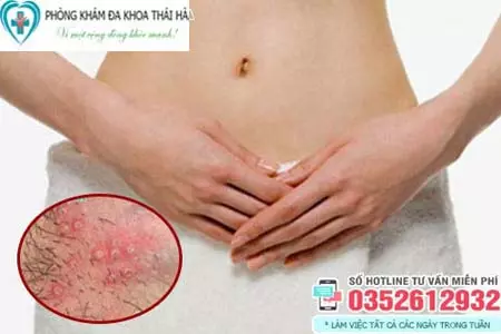 Nguyên nhân nổi mụn ở môi lớn vùng kín