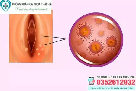 Nổi mụn ở môi lớn vùng kín là bệnh gì