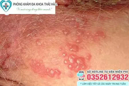 Hình ảnh ngứa vùng kín nữ