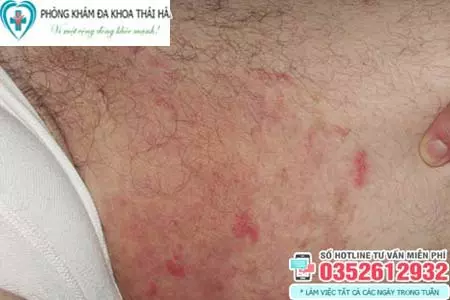 Hình ảnh ngứa vùng kín ở nữ