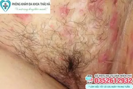 Hình ảnh ngứa vùng kín ở nữ giới