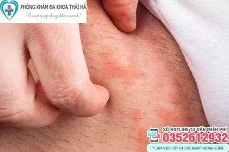Hình ảnh vùng kín bị ngứa ở nữ