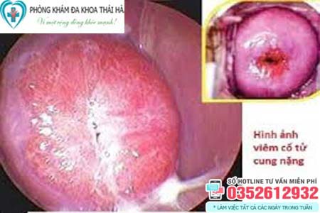 Hình ảnh bệnh viêm phụ khoa do viêm cổ tử cung