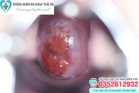 Hình ảnh viêm nhiễm phụ khoa do viêm lộ tuyến cổ tử cung